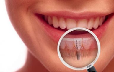 Implante dentário: a solução para o seu sorriso