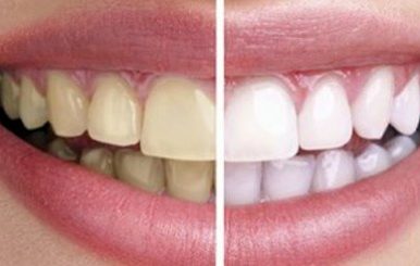 Como remover manchas nos dentes